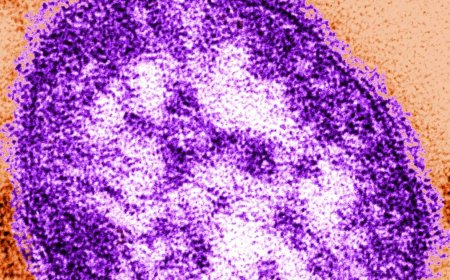 Measles outbreak declared in Snohomish County