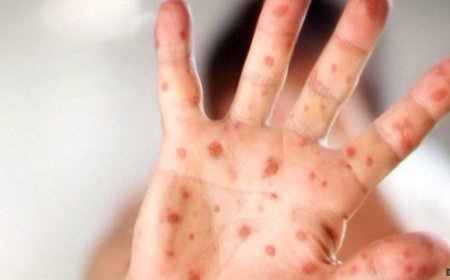 Adult with measles visited high school in Clark County while contagious, officials say