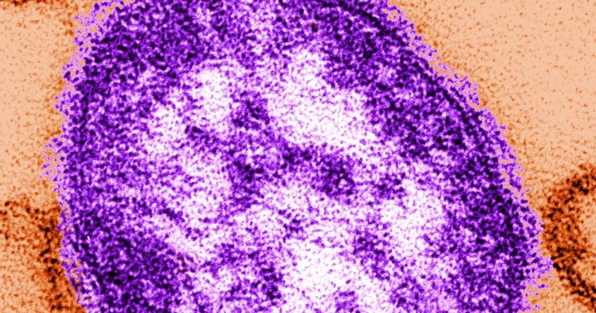 Measles outbreak declared in Snohomish County